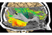 3D Slicer - Brain Fibrin.png